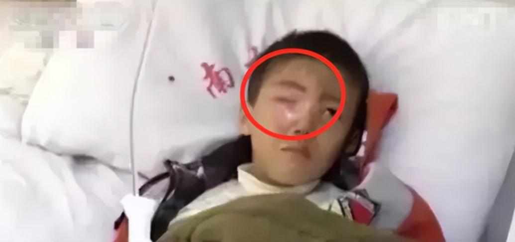 20分钟孩子眼球被融化了,男孩眼睛被融化了