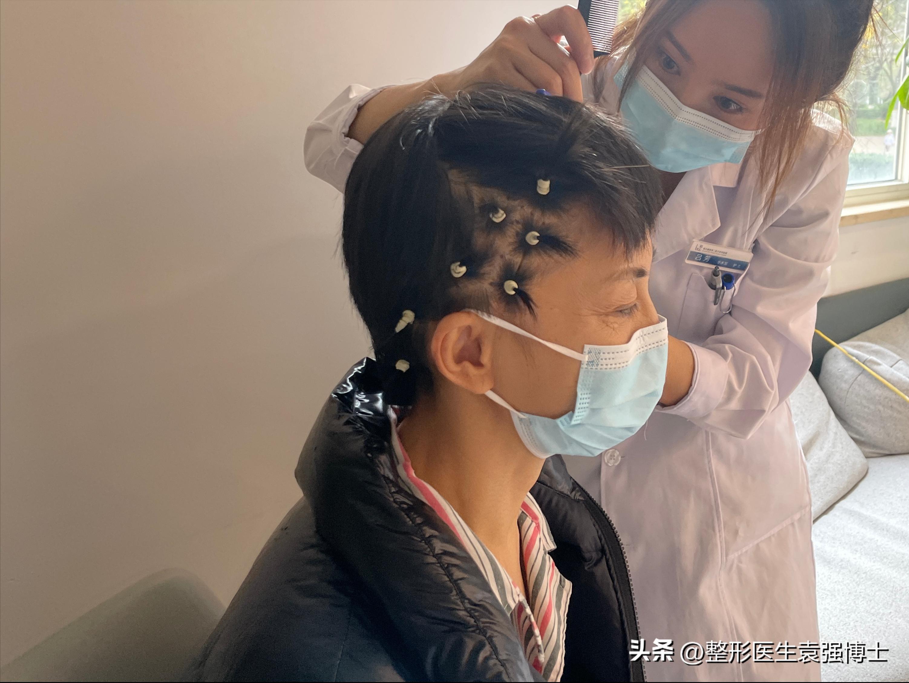 57岁脸又瘦又松，从广州来北京做大拉皮，即刻照镜子“没敢认”