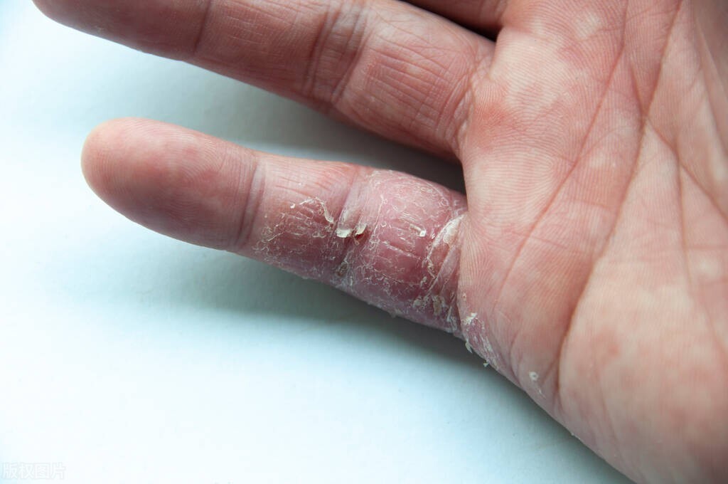 湿疹反反复复不见好怎么办,瘙痒没有皮损是湿疹吗