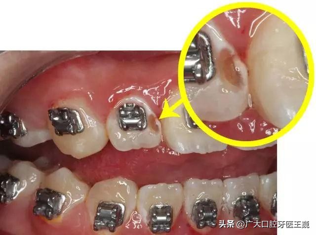 隐形牙套上面有白点,牙套上的白点是什么