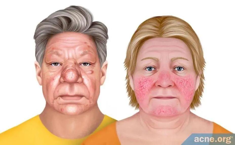 让人崩溃的酒渣鼻，这些日常护理重点你知道吗？