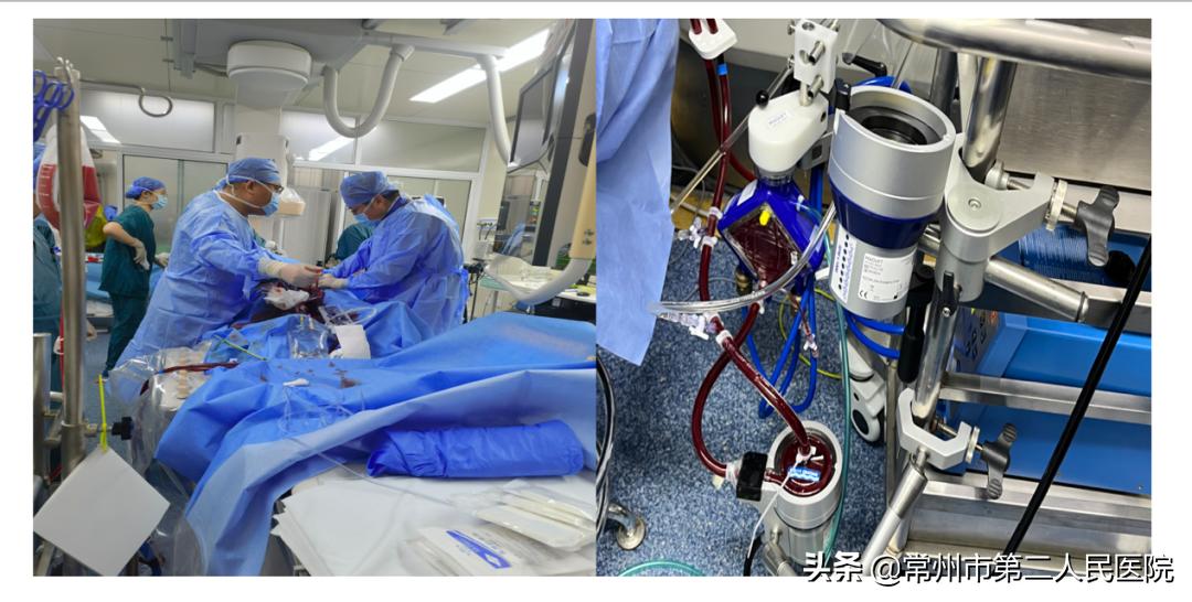 常州二院心内科团队完成省内首例ECMO支持下室速电风暴射频消融