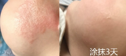 婴儿面霜到底能不能用,含有地塞米松的婴儿面霜