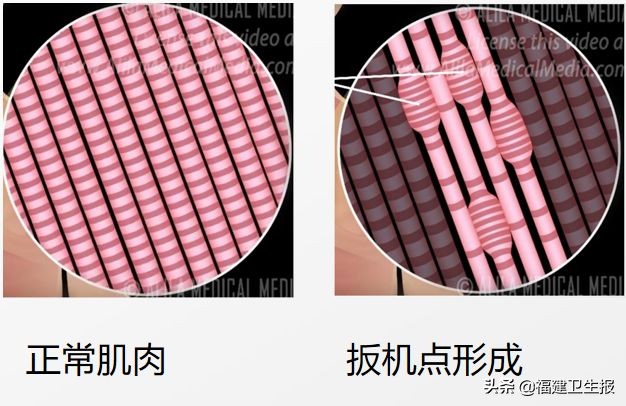 莫名疼痛抗生素也无效，被疑精神病！没想到是…女性注意了