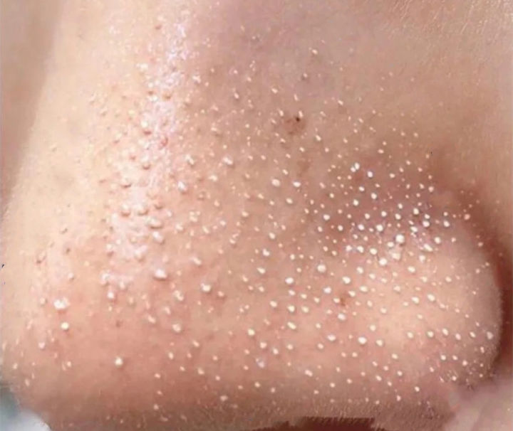 超微小气泡美容有用吗,美容院小气泡