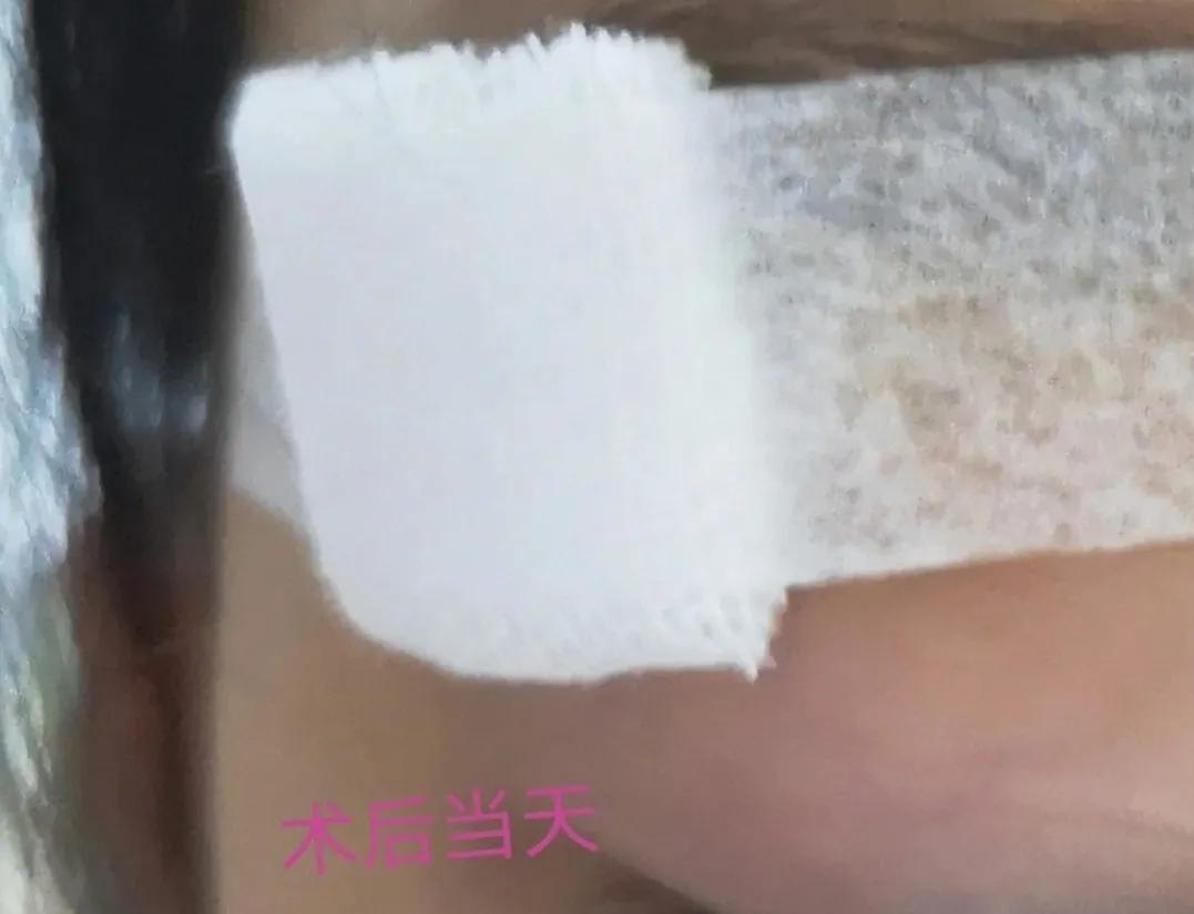 皮脂腺囊肿和粉刺瘤,火针治疗皮脂腺囊肿