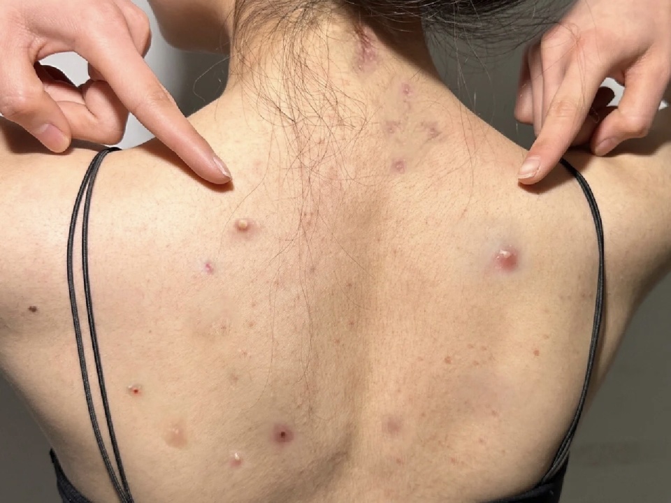 后背祛痘最有效的沐浴露,哪几款沐浴露可以有效去背痘