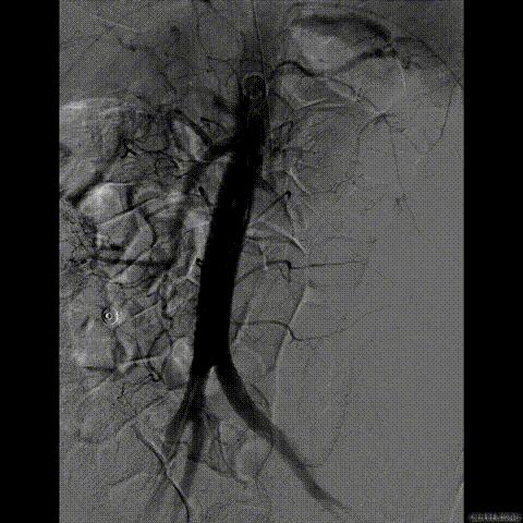 病例回顾与分享,腹膜后血肿介入治疗