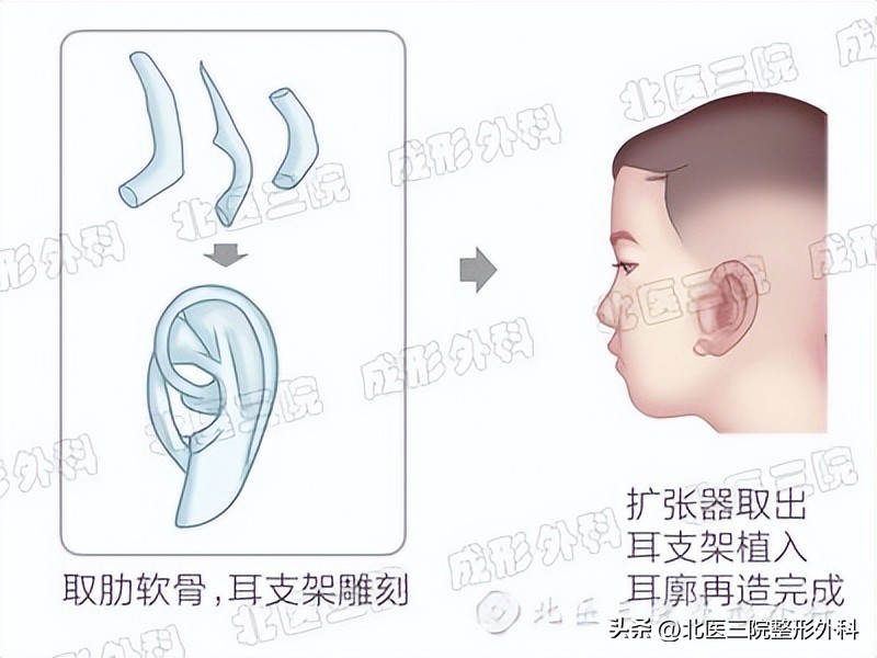耳廓再造的三个方法,双侧无优势会影响移植吗