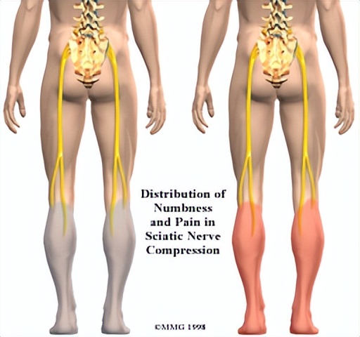腰椎间盘突出怎样让它缩小,腰椎间盘突出最快缓解方法学生