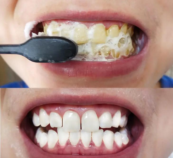 牙渍牙黄用什么牙膏刷牙,牙齿黑用什么刷牙可以让牙齿变白