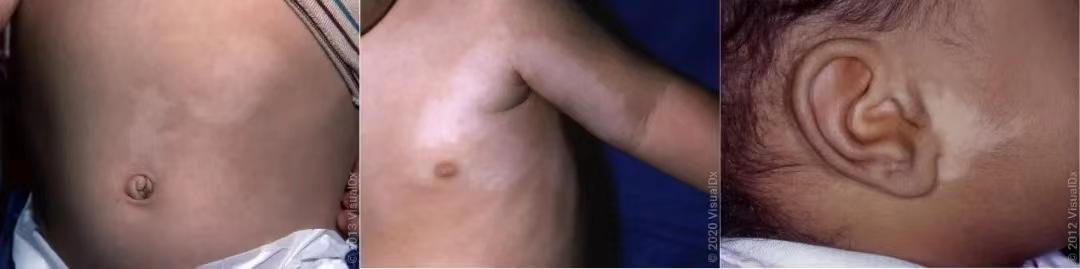 18种皮肤病白斑病,常见皮肤病斑