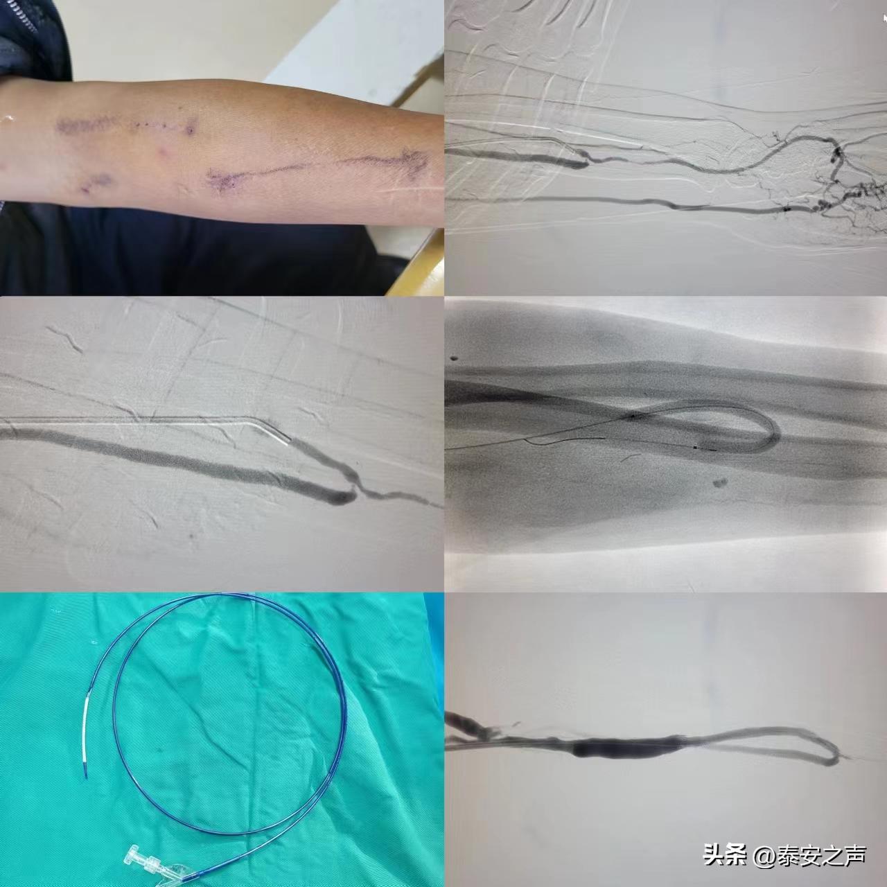 喜讯！*安泰**八十八医院肾病内科完成*安泰**首例肝素涂层覆膜支架术