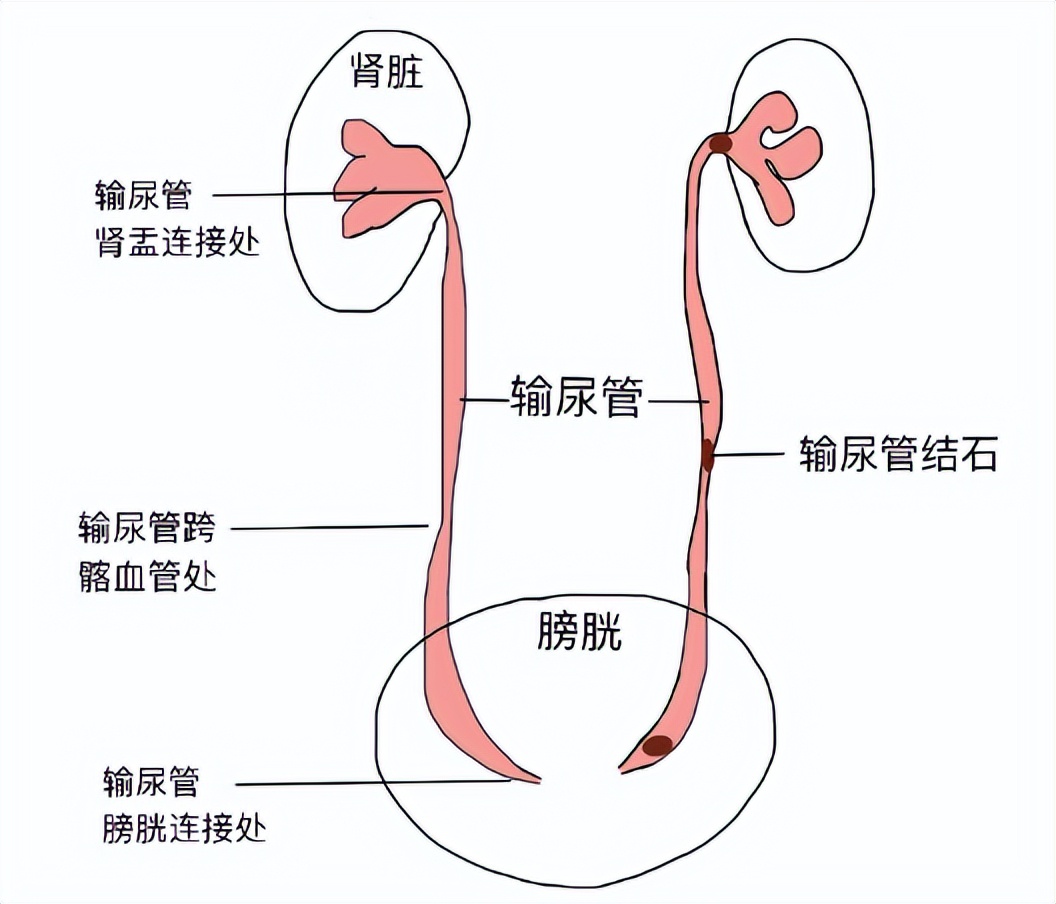 结石引发剧烈肾绞痛,该怎么办?常立高主任:这几个妙招要记住了