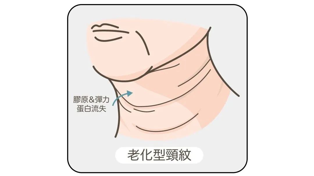 1条颈纹=显老10岁，可怕的颈纹还有救吗？