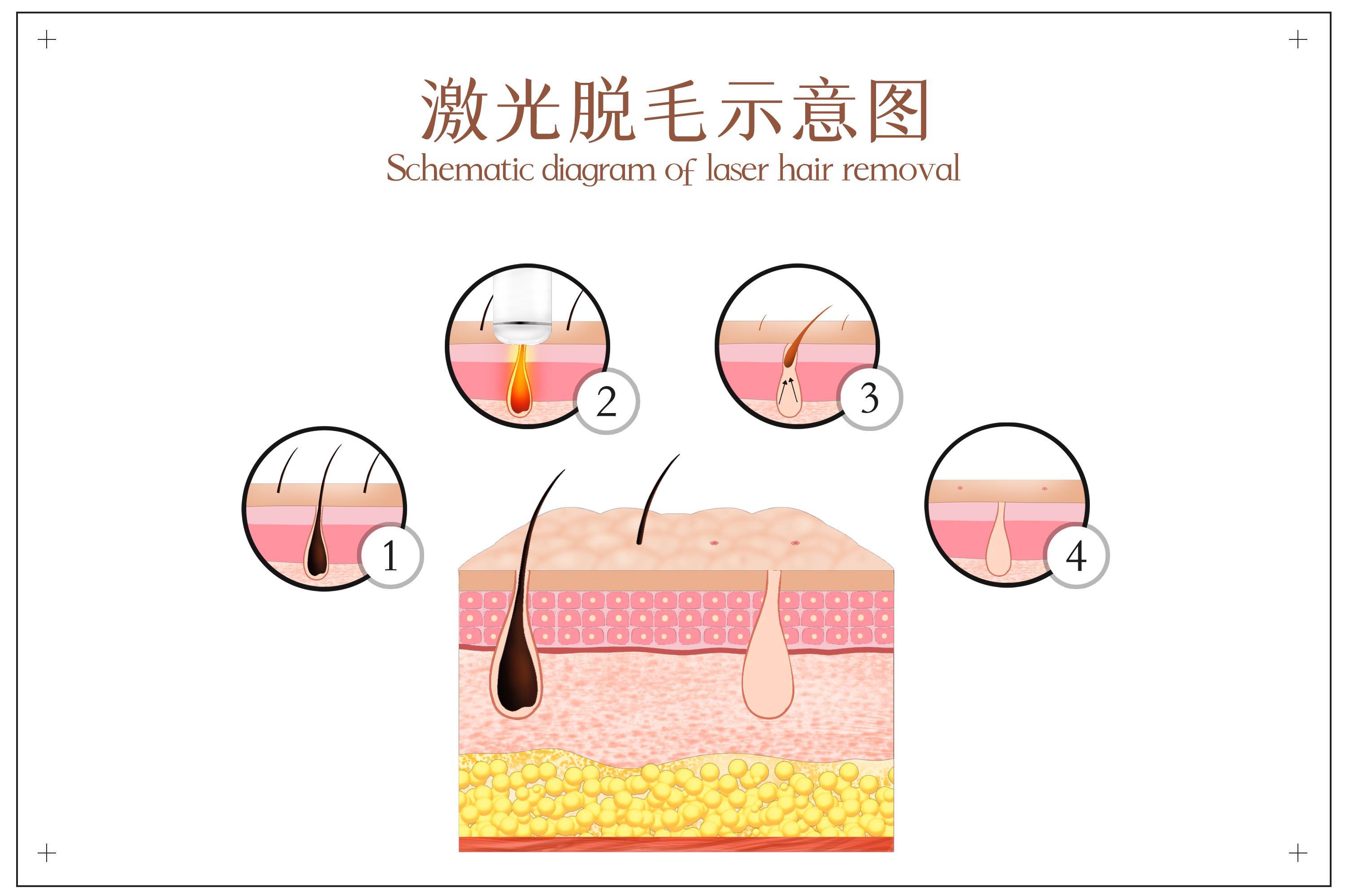 脱毛仪用起来的效果,脱毛仪的第一次使用中的效果