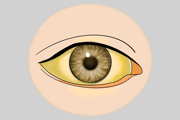 患有肝炎如何正确生活,有肝病的人可以不单身吗