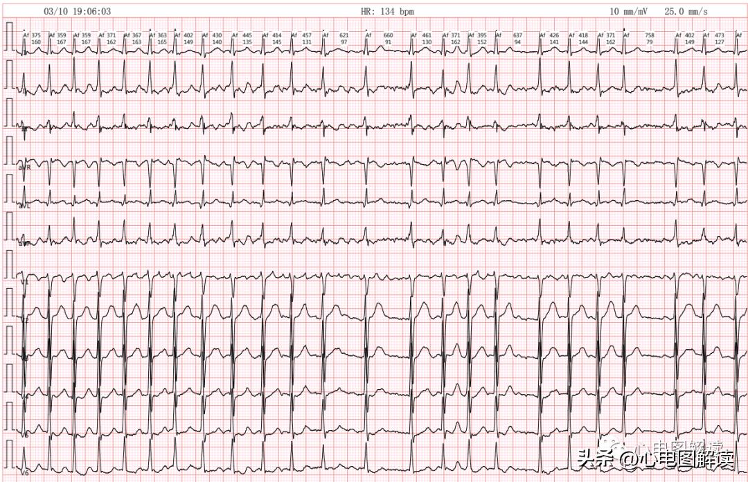 心房颤动伴长间歇能做射频消融吗,心房颤动伴停搏严重么