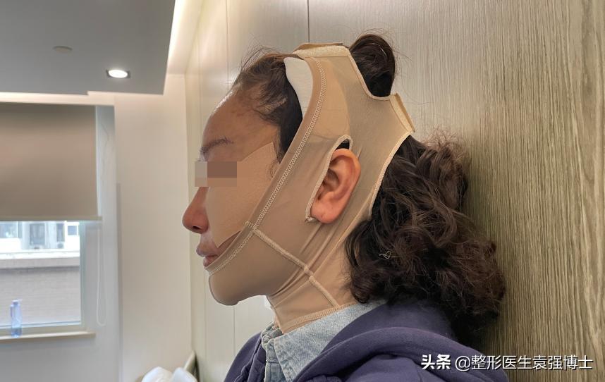 下颌缘拉皮提升前后对比图,小拉皮能改善下颌线吗