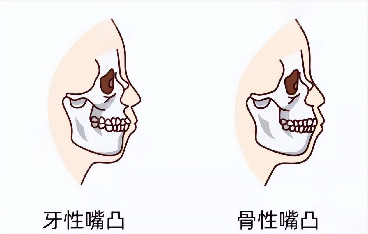 嘴突是什么导致的,嘴突是什么原因导致