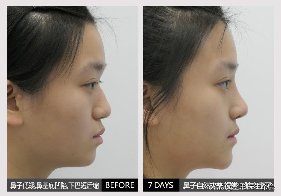 脸部整形手术成功案例,全脸整形耗时