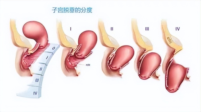 68岁老太，子宫从下面“掉”了出来？如何预防和应对子宫脱垂？