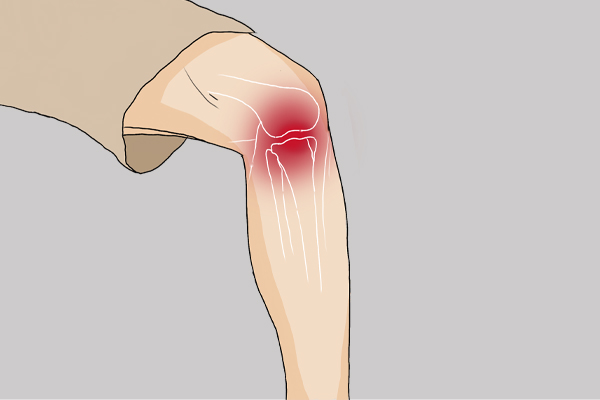 跑步对膝盖损伤有哪些,跑步伤膝盖看什么科