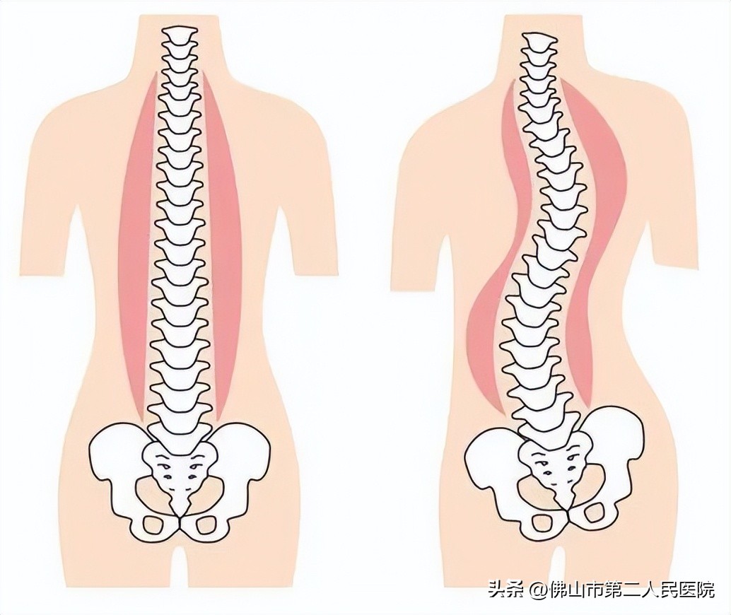 青少年脊柱侧弯，中医外治助力孩子挺起脊梁
