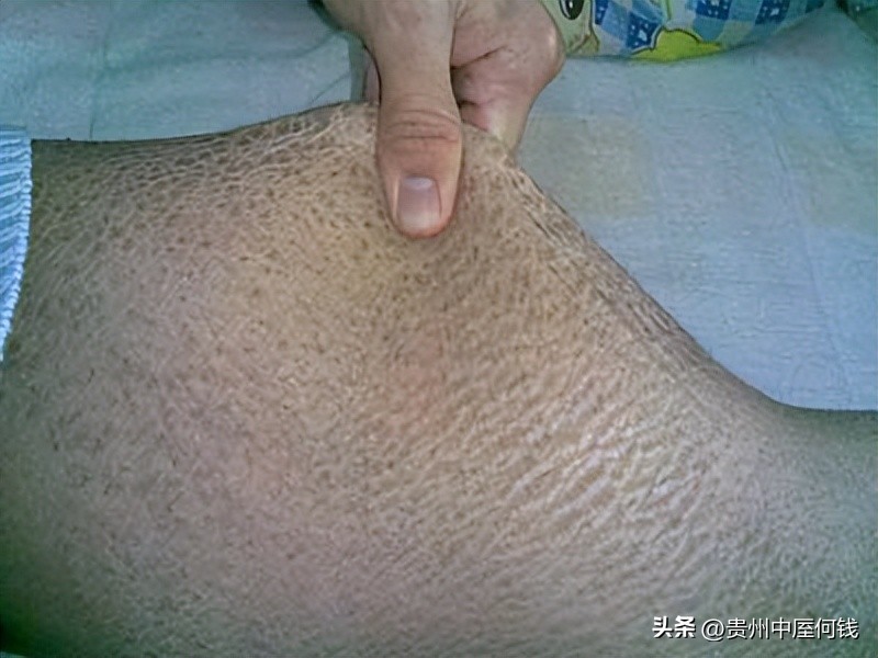 中医辨别皮肤病的方法,民间老中医看皮肤病有名
