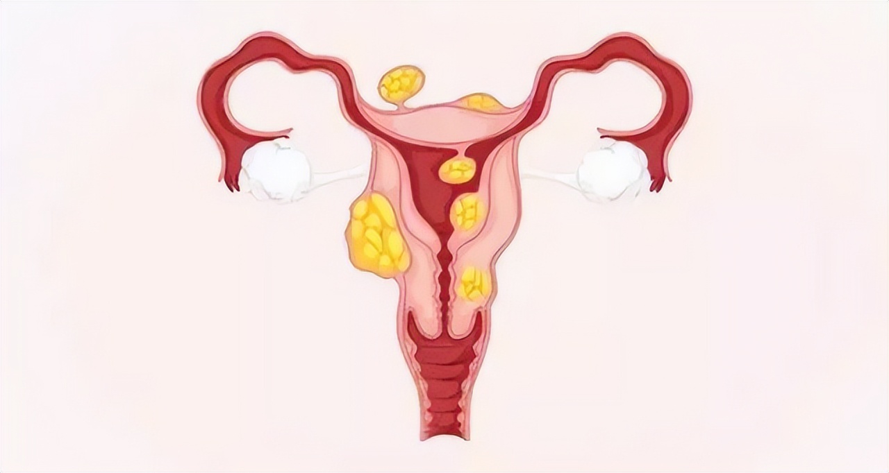 女性为何容易得子宫肌瘤,女性什么原因容易有子宫肌瘤