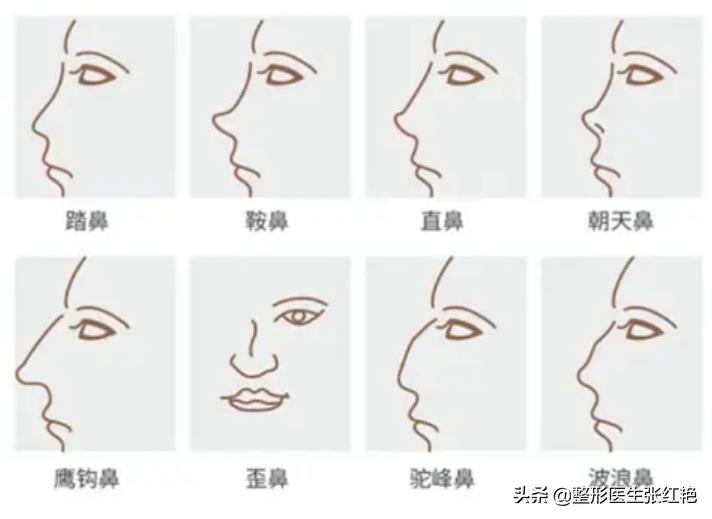 鼻子整形前后真实案例,鼻整形术中的鼻孔之美