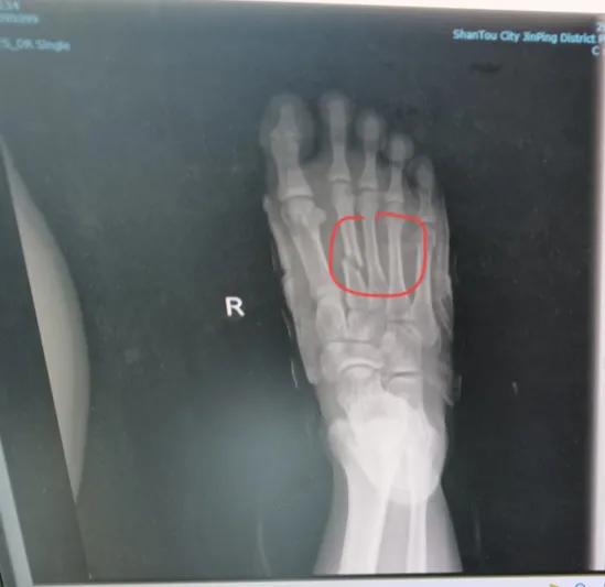 打篮球脚被踩了一脚很痛,大学生打篮球脚受伤