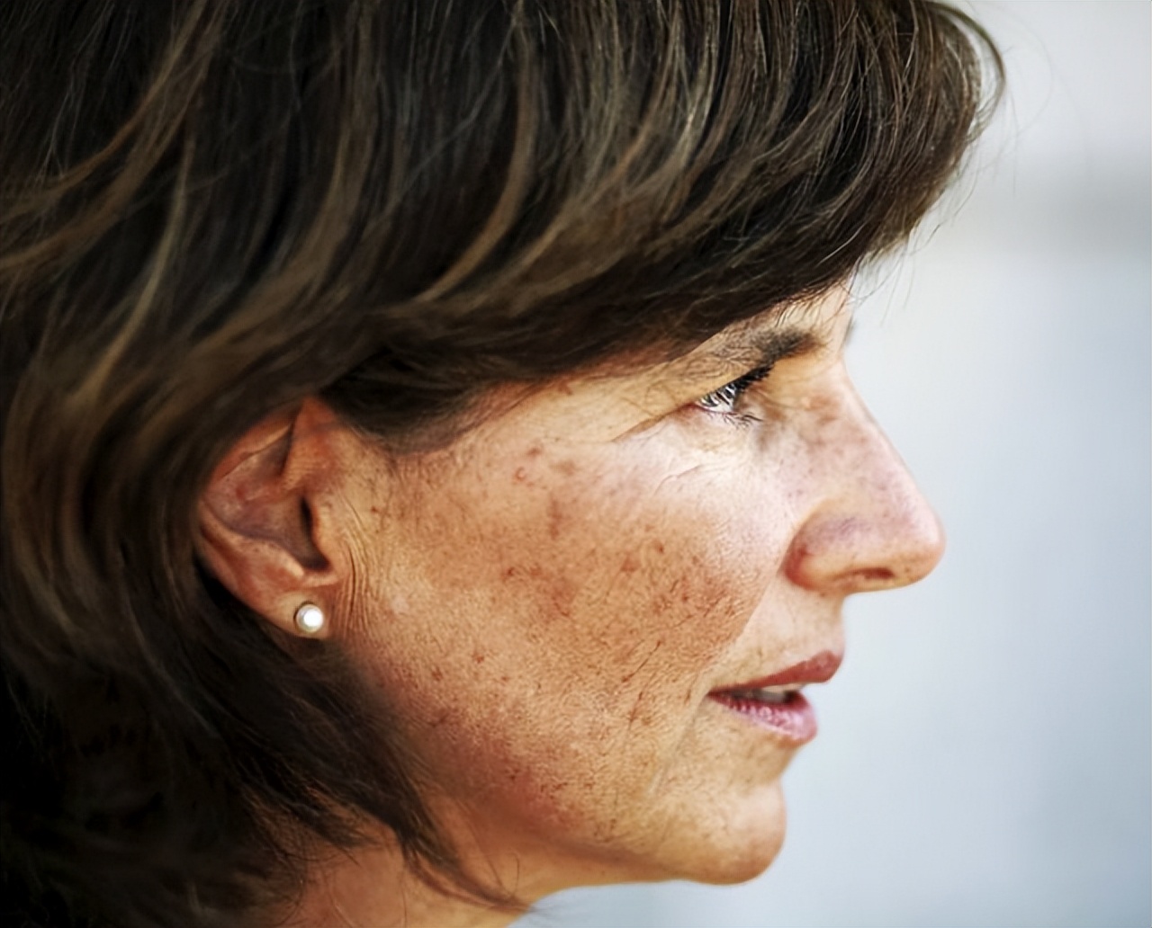 老年斑越来越多教你个好办法,为啥有的老年人老年斑越长越多