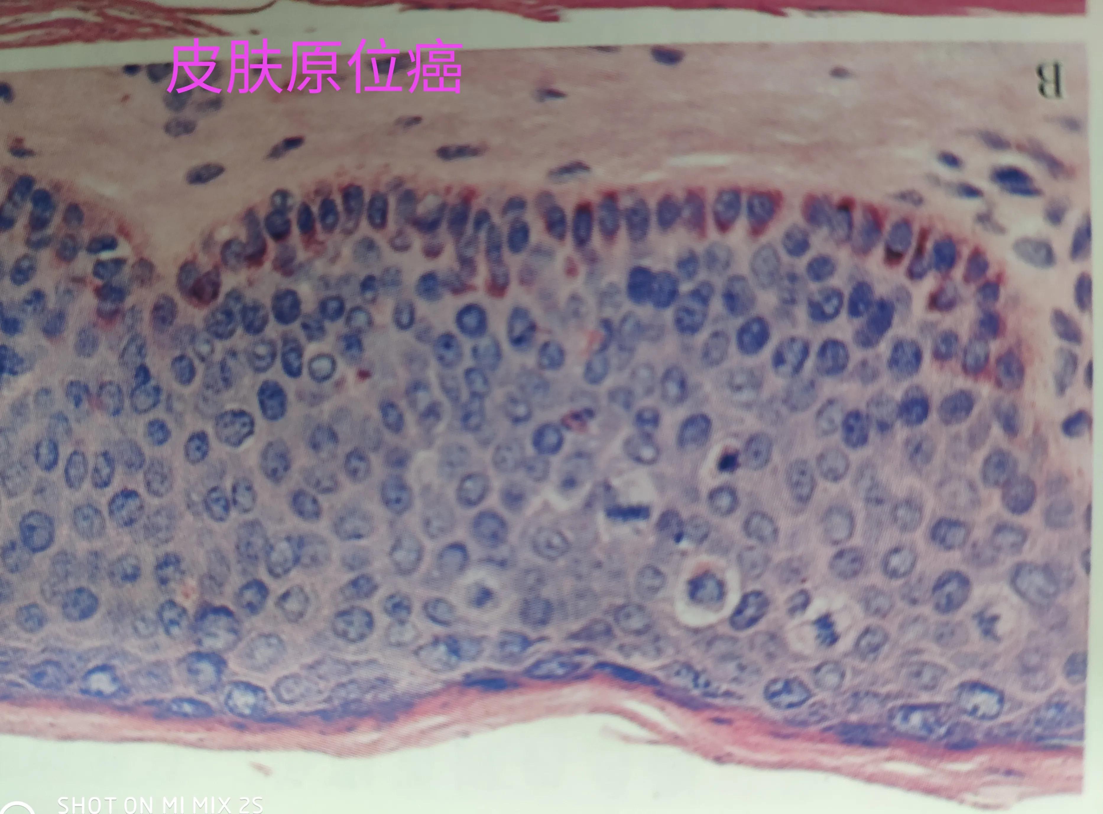 什么是原位癌?与浸润癌有何区别?原位癌会转移吗?