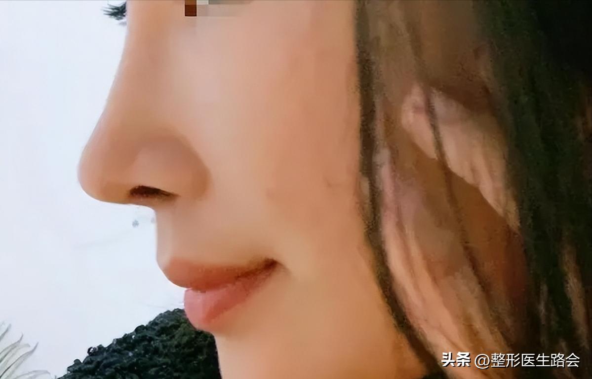 你对隆鼻整形有什么看法,鼻部整形大家最关心的话题