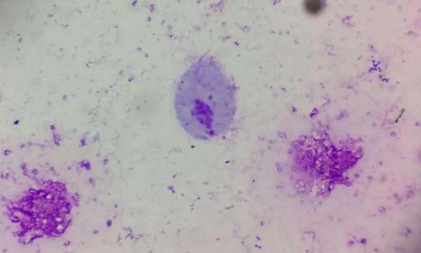 外阴瘙痒的原因外阴炎用什么药,外阴瘙痒是炎症引起的怎么办