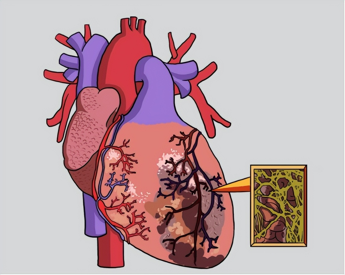 冠心病诊断预测模型,建模预测冠心病