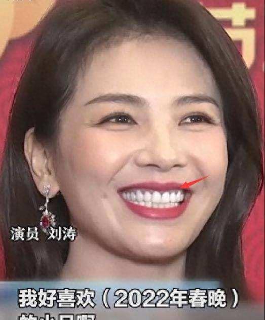 明星烤瓷牙发黑,明星烤瓷牙牙齿磨小后照片