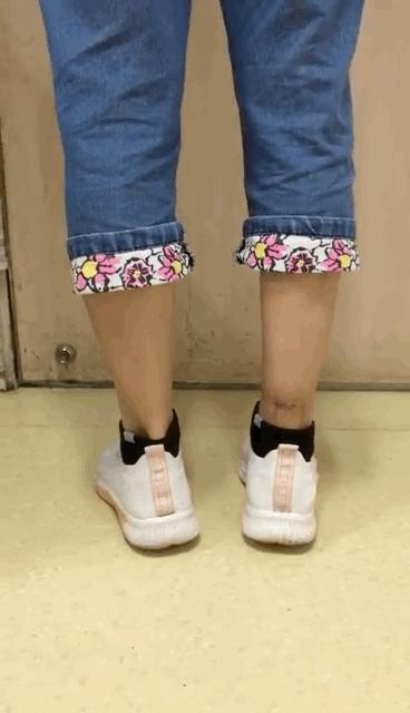 #非常病例#跳广场舞导致跟腱断裂，微创修补重返舞台