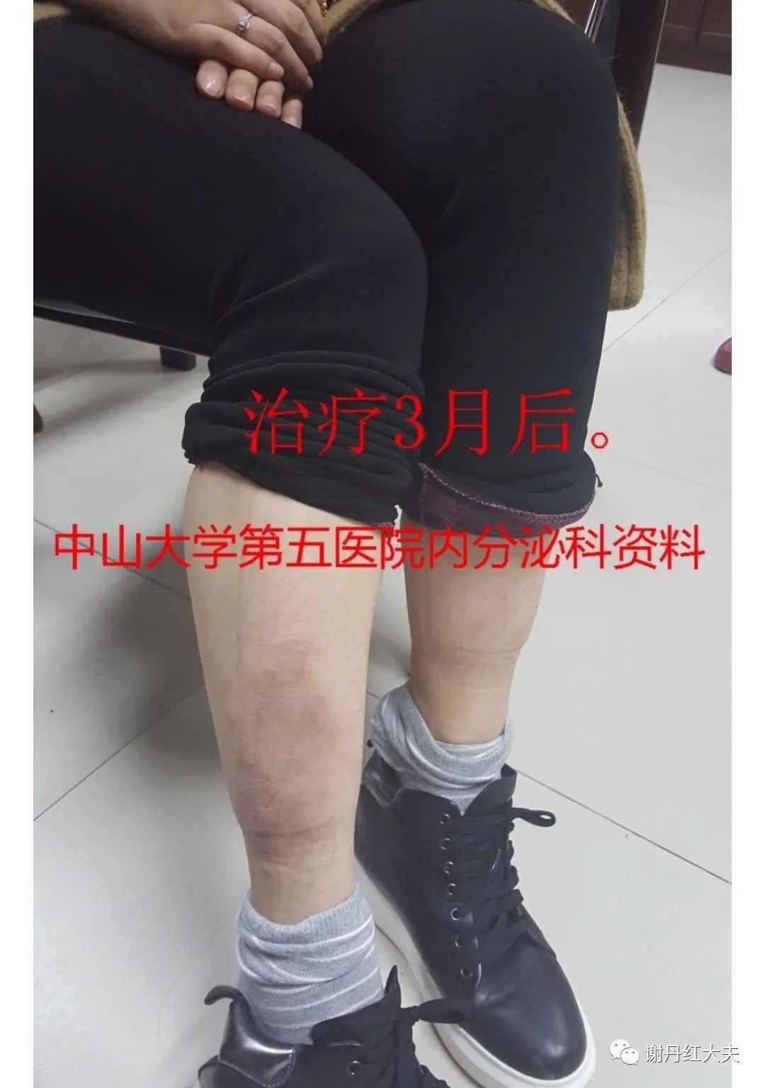 胫前黏液性水肿见于哪些病,胫前黏液性水肿为凹陷性水肿吗