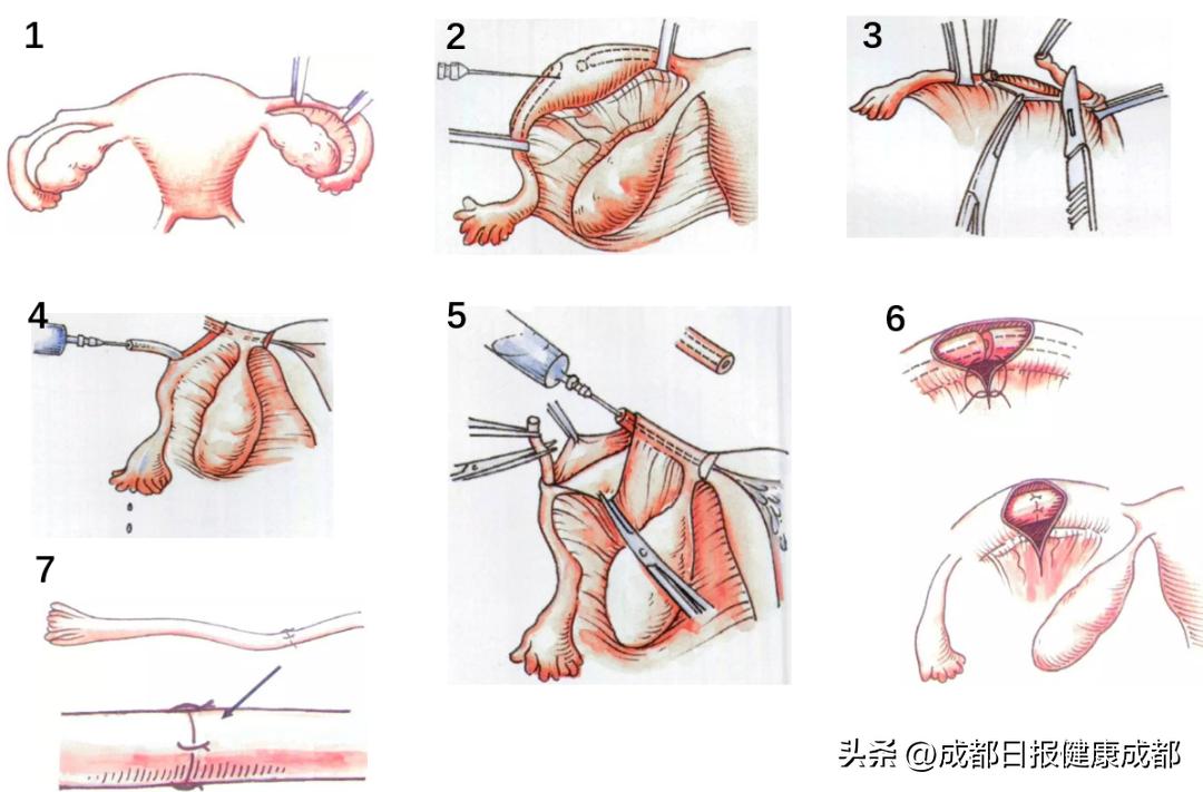 输卵管复通手术亲身经历,健康医学科普希望能帮到你