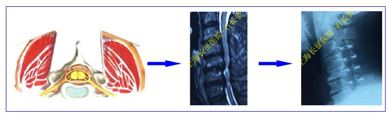 颈椎病是什么病要怎么治,颈椎病是怎样的症状