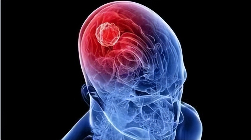 儿童患上脑肿瘤怎么办？这3种常见的治疗方法，可供家长选择