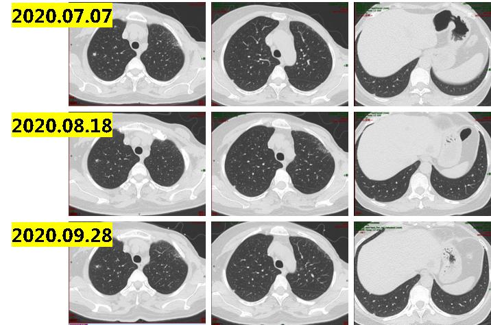 乳腺癌晚期没多少钱怎么治疗最佳,经济困难癌症晚期可以放弃治疗吗