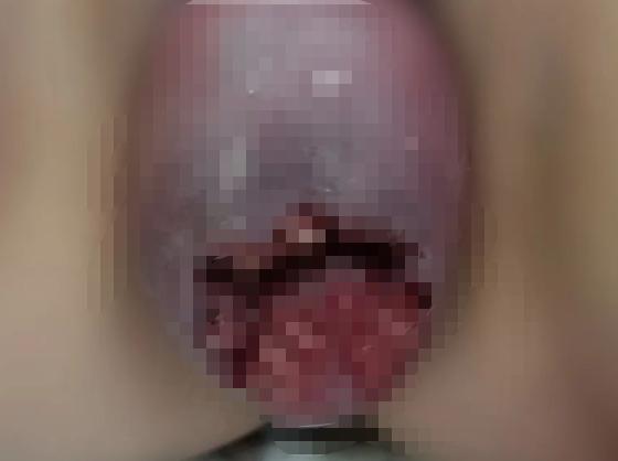 孕妈子宫“掉”到阴道口！备孕二胎，这件事一定要做