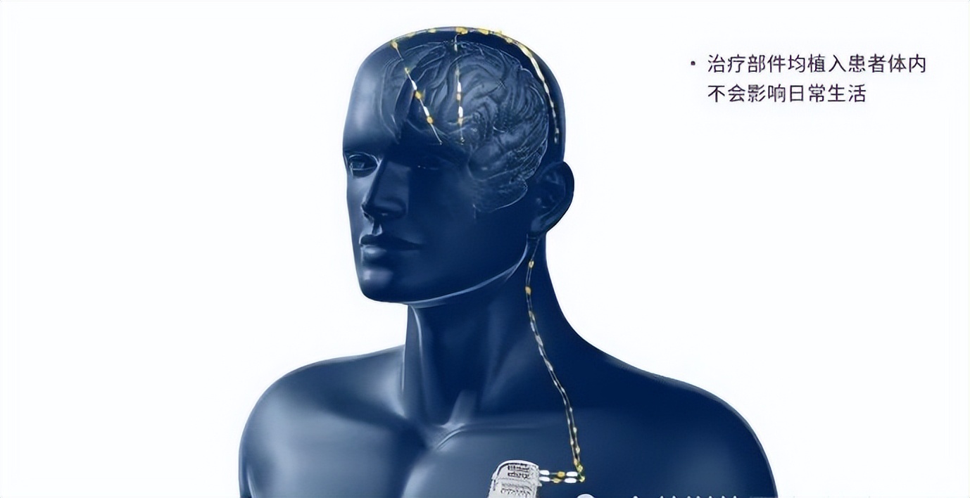 智能可感知脑起搏器植入手术,山西省首例机器人植入脑起搏器