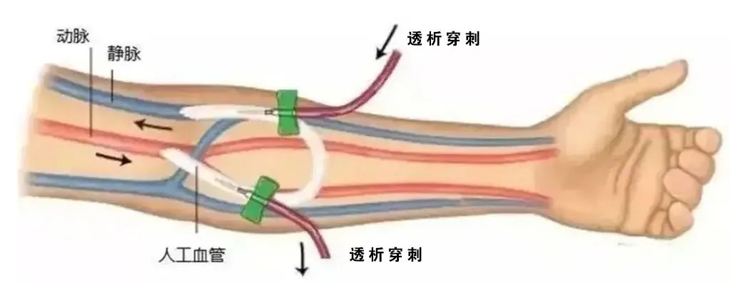 血管造瘘透析,血管人工搭桥