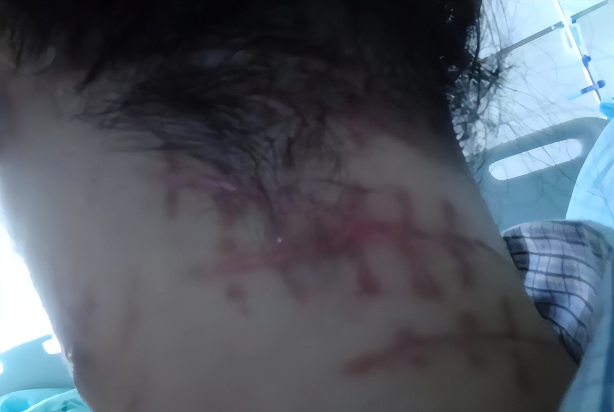 女子被入室抢劫自救后续,女子遭入室抢劫身中数刀装死逃生