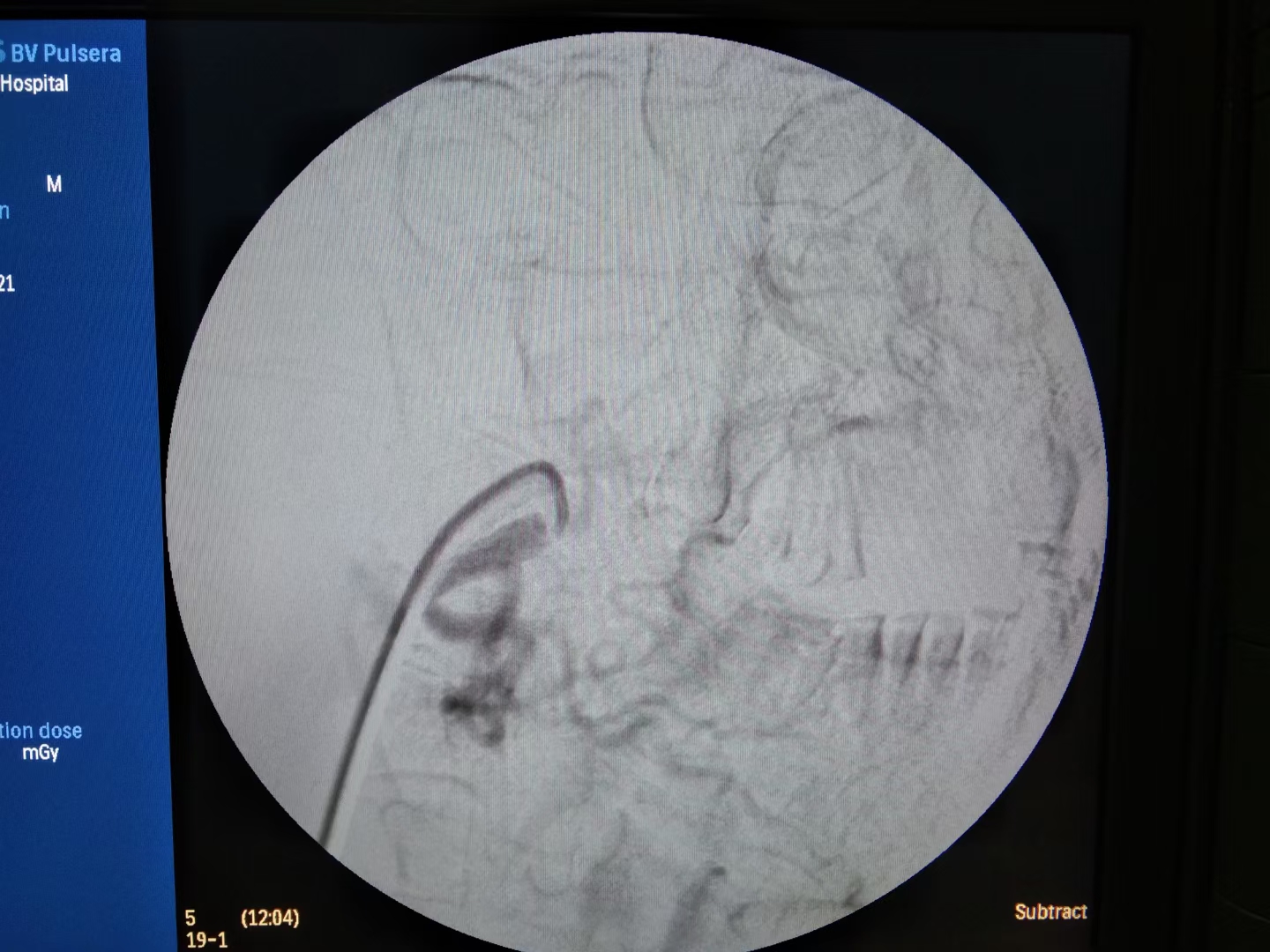 「病例分享」舌癌患者突发大出血，燥动不安，介入治疗成功止血