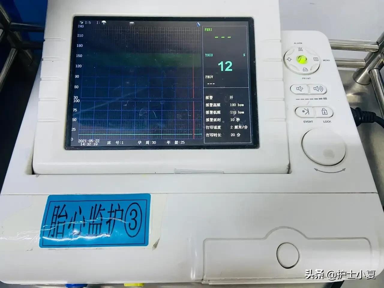 胎儿心律失常怎么办,胎儿心律失常呈三联律